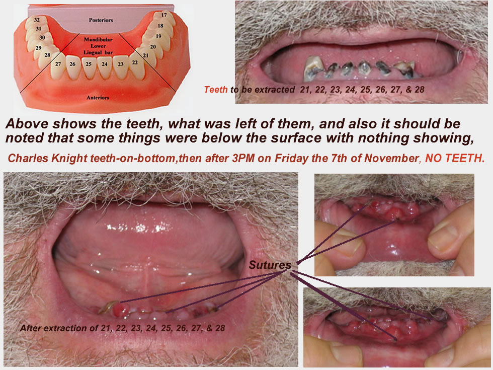 teeth-charlies before and after extractions