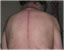 back incision image