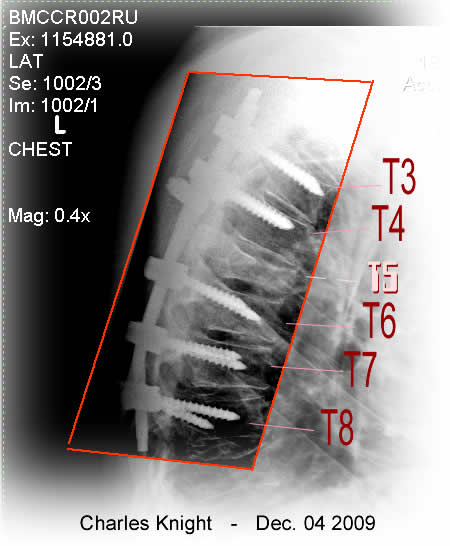 x-ray image showing screws in t3, t4, t6, t7, and t8  t-5 was burst on impact