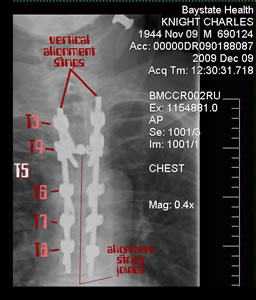 close-up of xray shown screws in back as seen through the body from the front